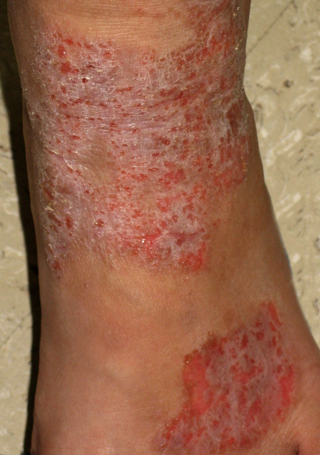 Ch. 3: With secondary infection