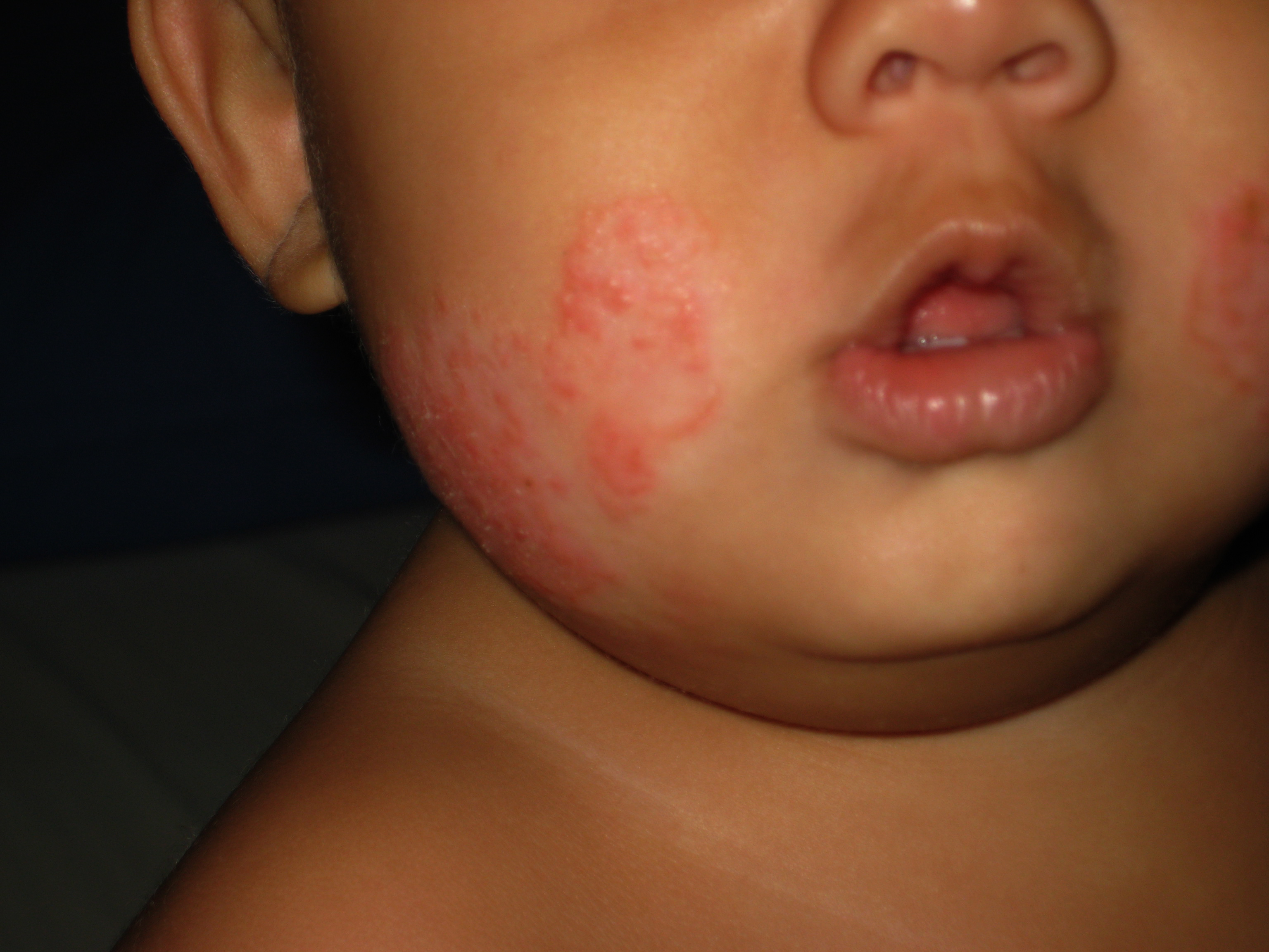 Ch. 3: With background hypopigmentation