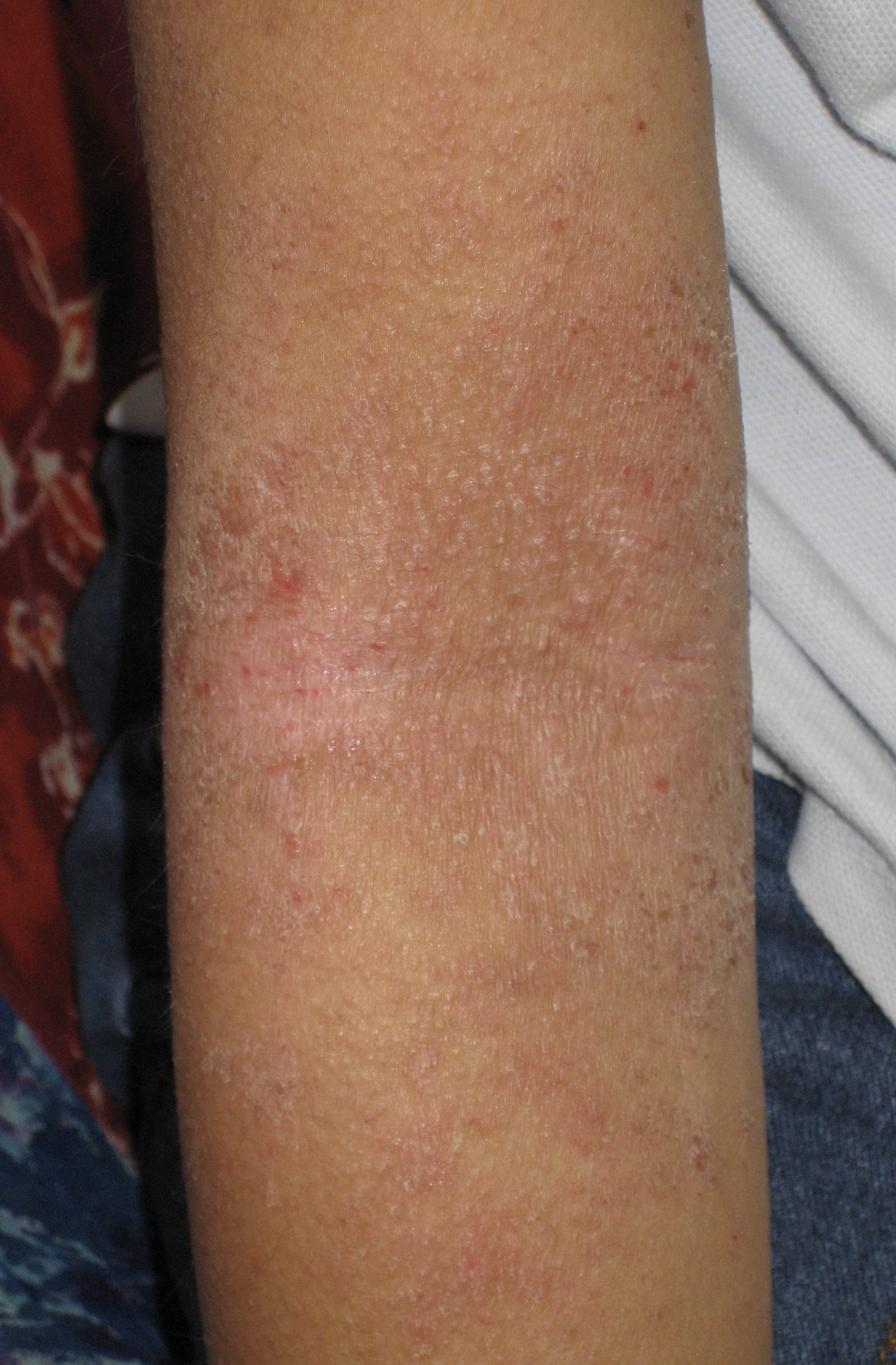 Ch.3: Typical anticubital fossa plaque