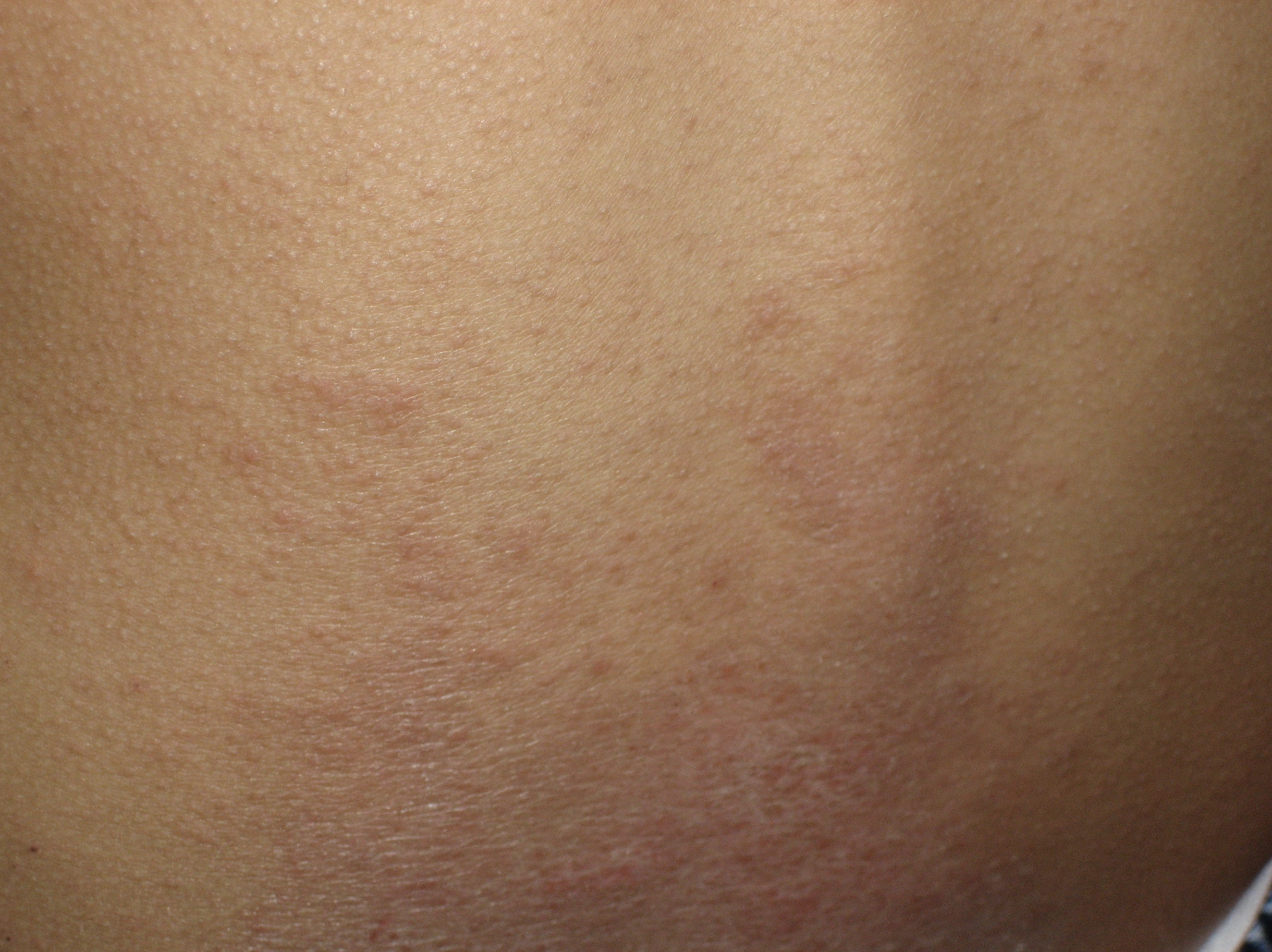 Ch. 3: With follicular prominence