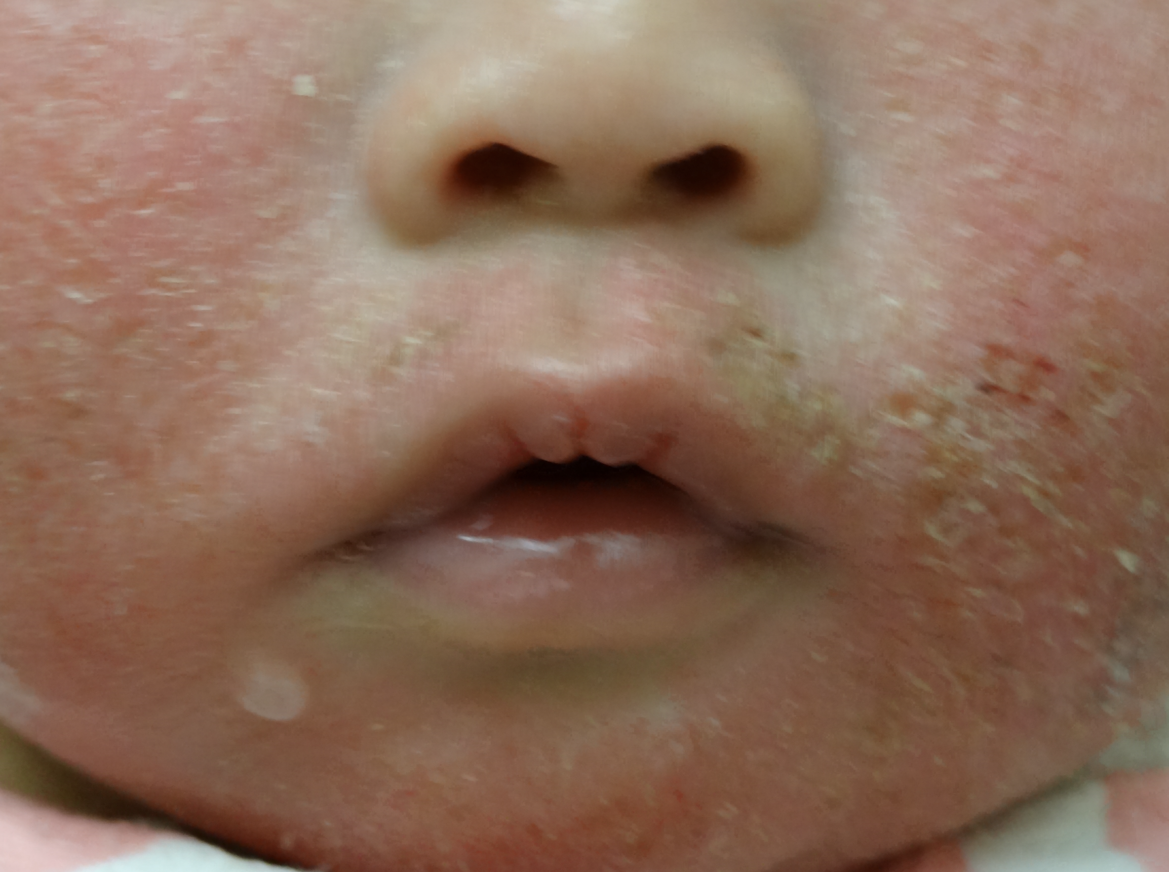 Ch. 3: Typical facial plaques in infancy