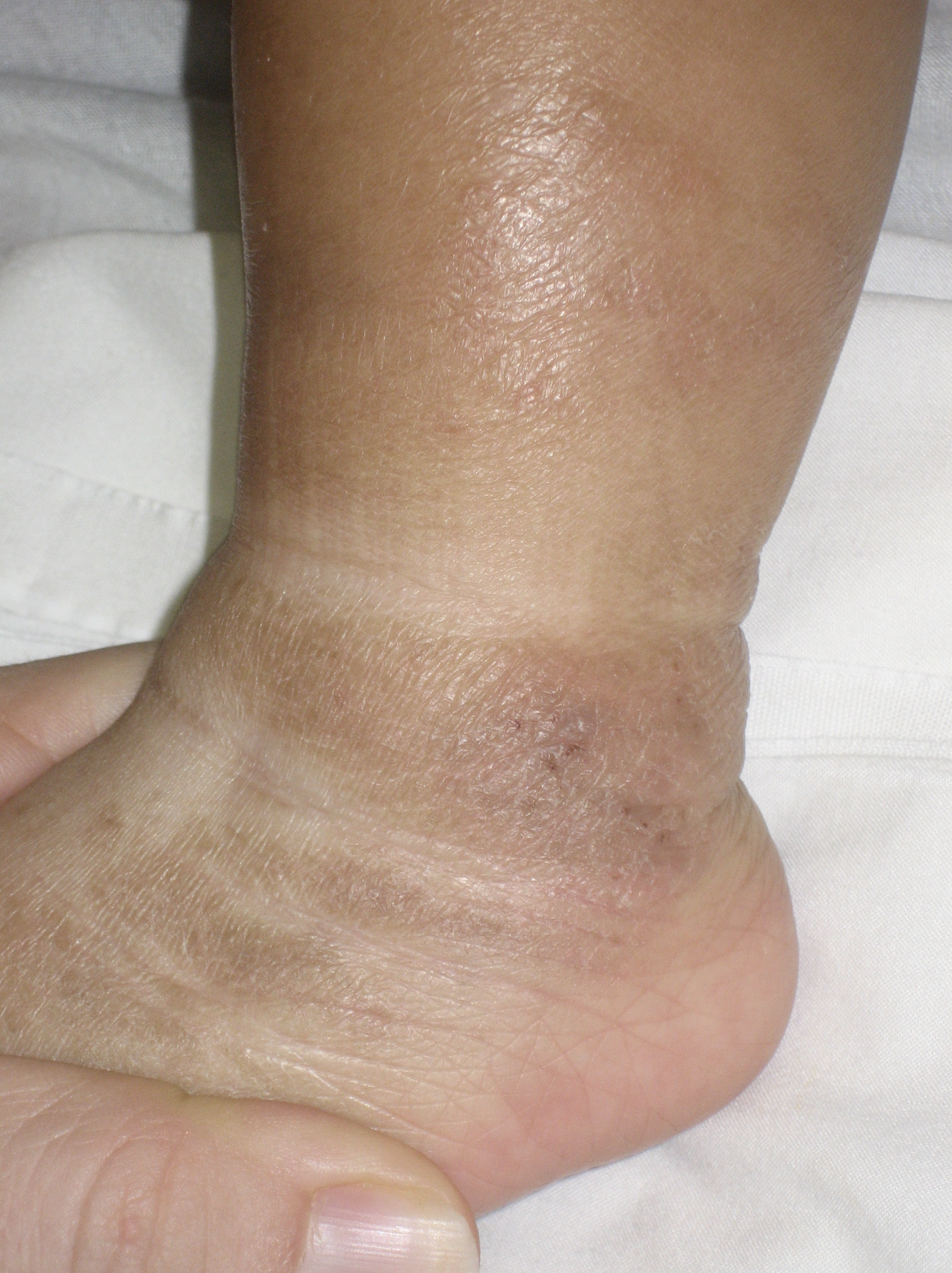 Ch. 3: Lichenification at the ankle