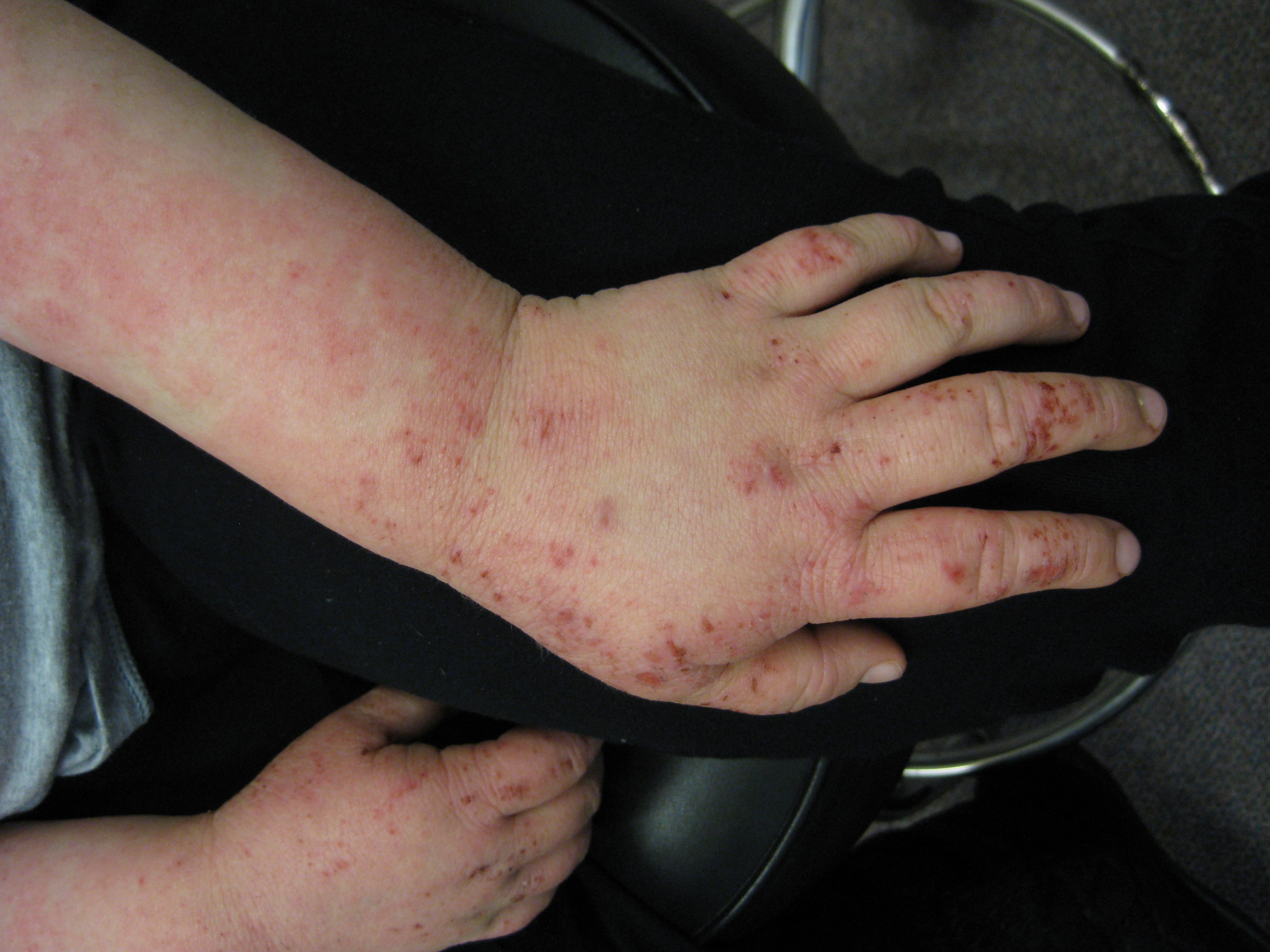 Ch 3: Atopic dermatitis with excoriations on the dorsal hands