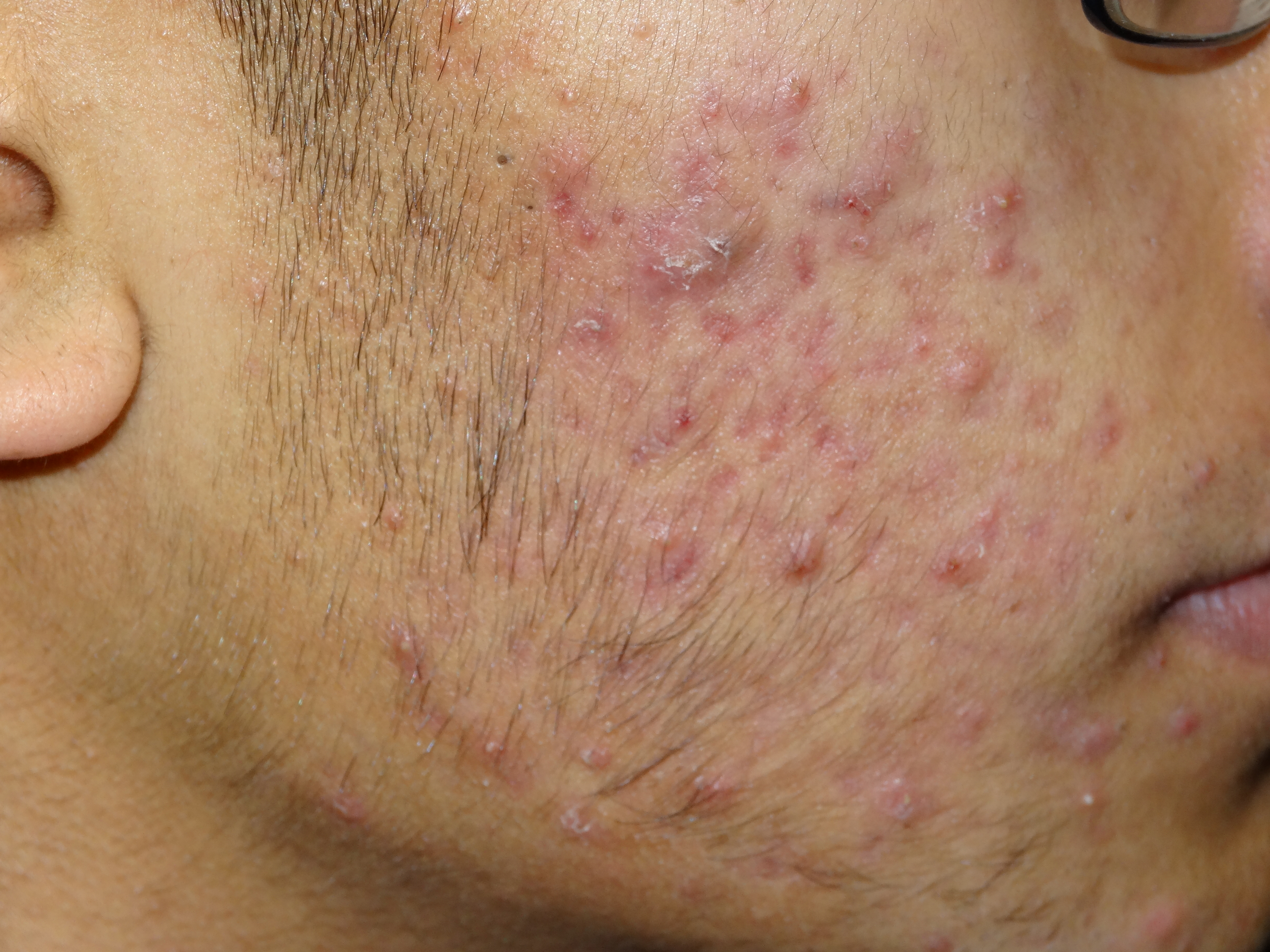 Ch 5: Inflammatory papules and pustules 