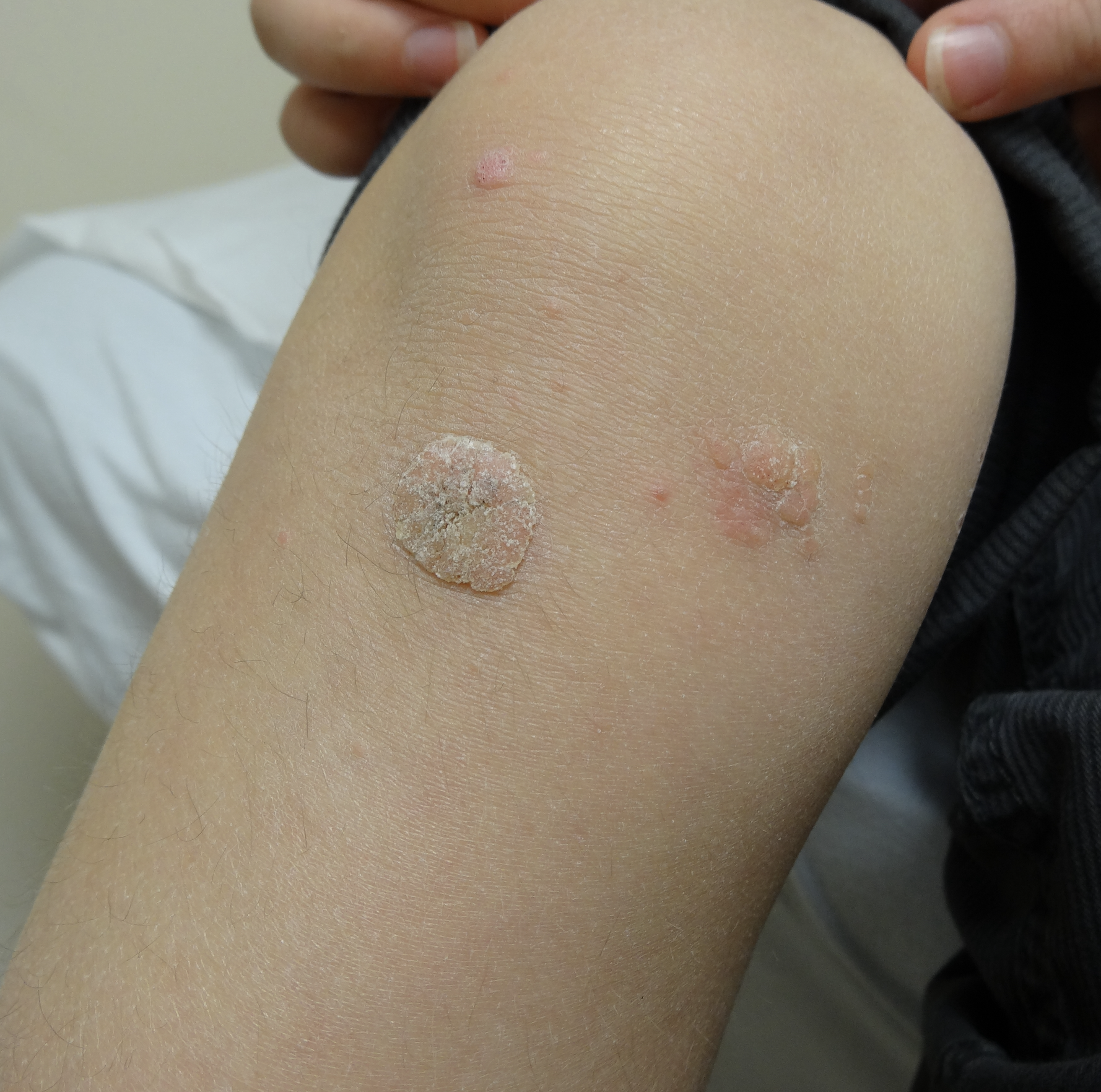 common warts on knee