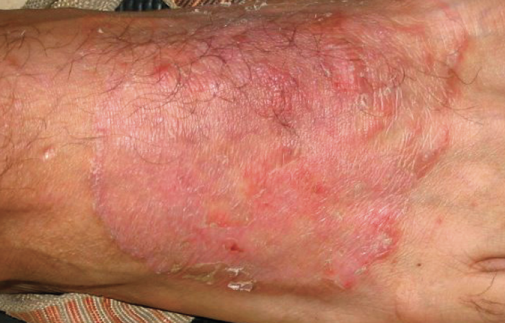 Fungal Infections: Tinea Corporis – Pediatric Dermatology