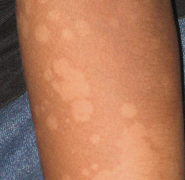 Ch 6: PV: Hypopigmented macules coalescing into patches