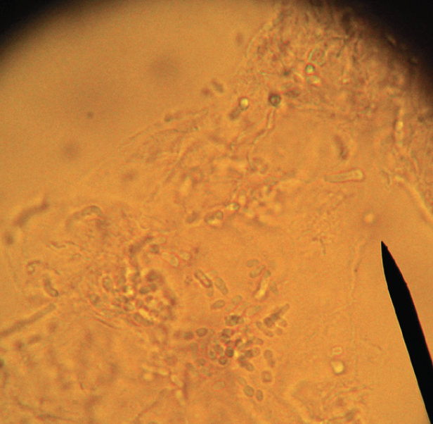 Ch.6: KOH prep (40x power) shows spores and short hyphae