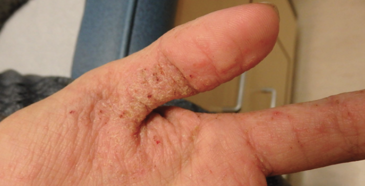 Ch 6: Pruritic scaly and crusted plaque on hand