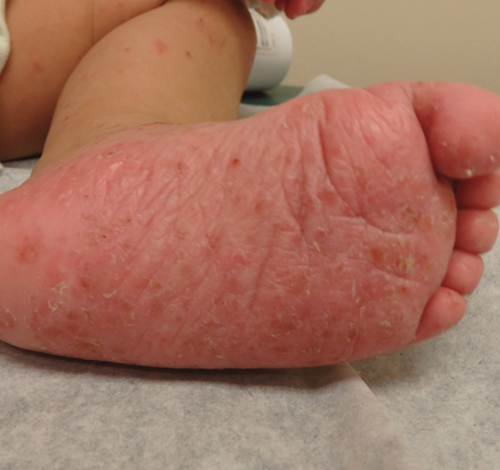 Ch 6: Scabies: Papules, pustules, and burrows on an infant&#039;s foot