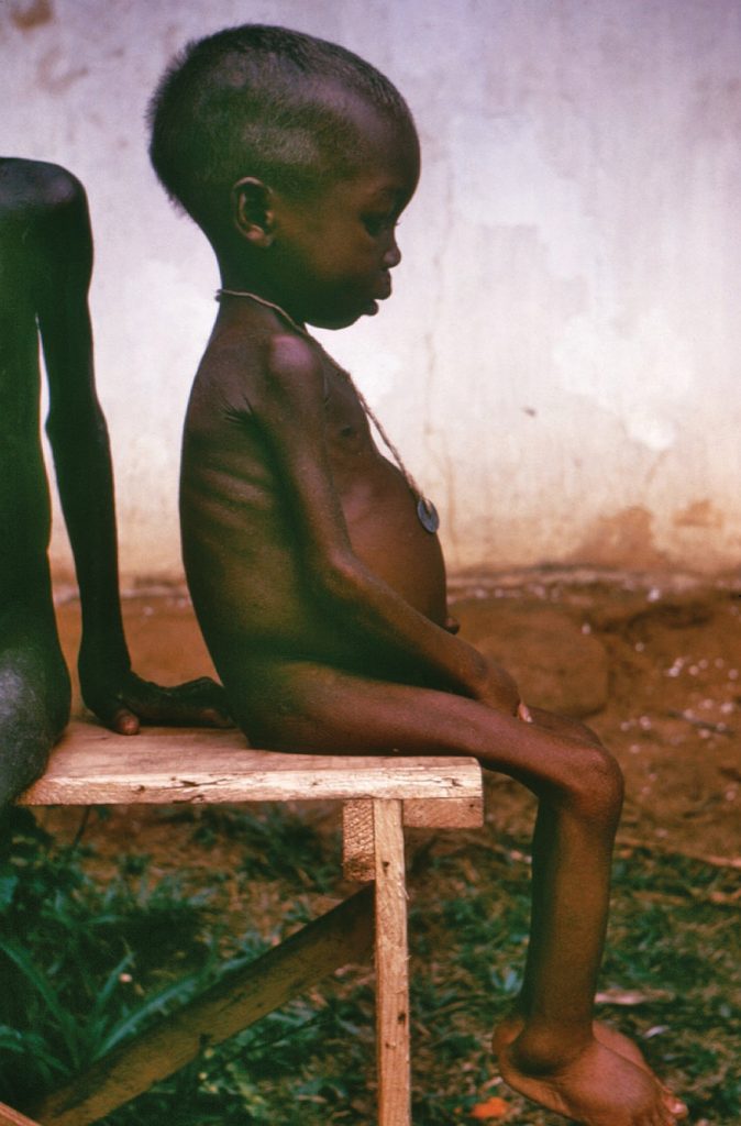 Boy with Kwashiorkor disease sitting in chair
