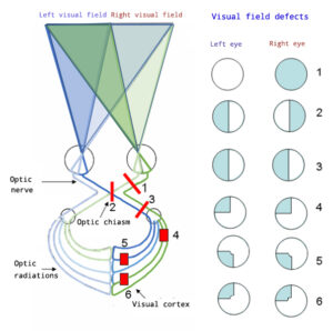 Schematic of visual fields and visual of 6 types of visual field defects